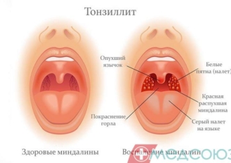 Тонзиліт – сезонне захворювання, чи підступний хронічний ворог?