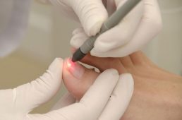 Лазерне лікування грибка нігтів