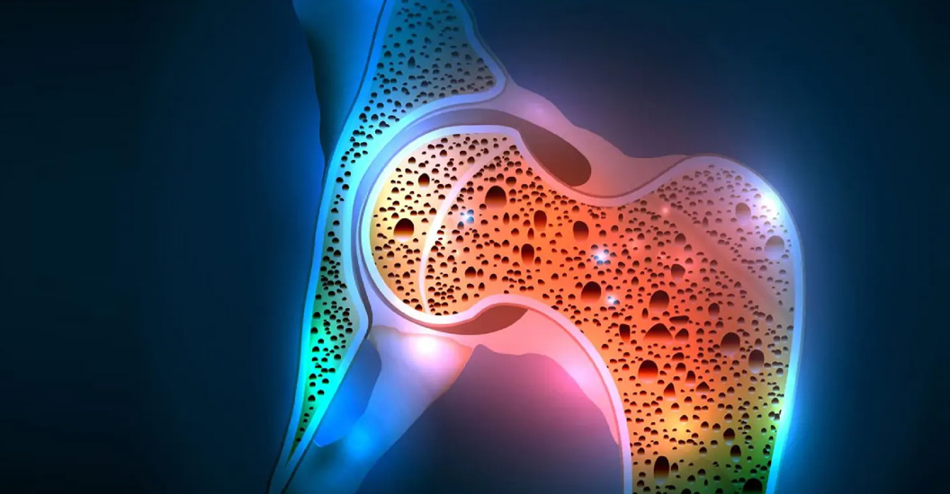 Остеопороз: почему важно своевременно обследоваться и лечить